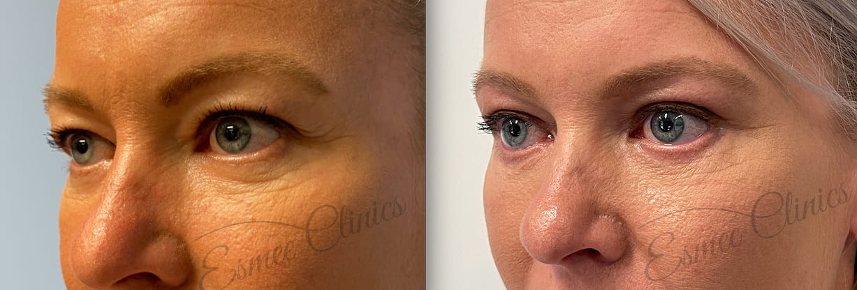 Before and After img